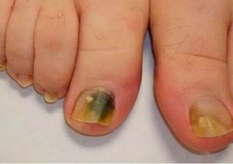 A infección afecta ás placas das uñas