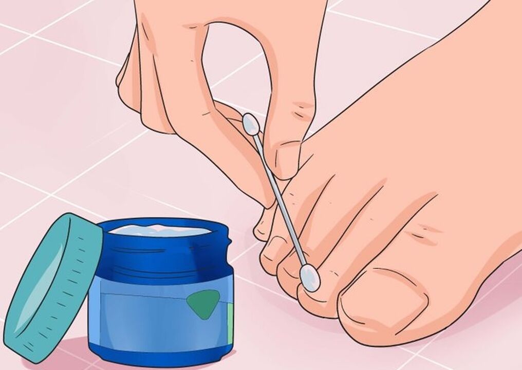 Cura o fungo das uñas