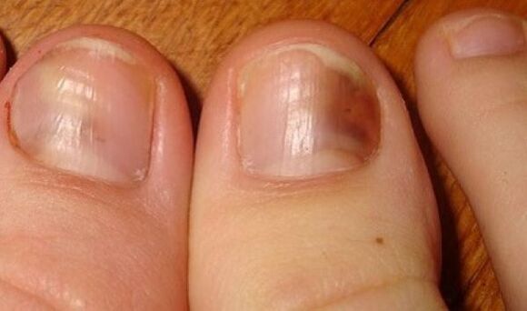 unhas afectadas por fungos