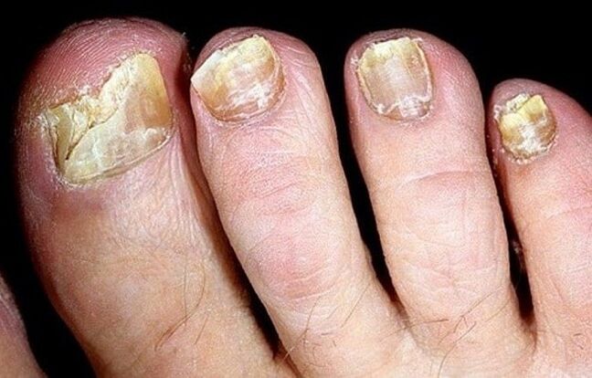 fungo nas unhas dos pés
