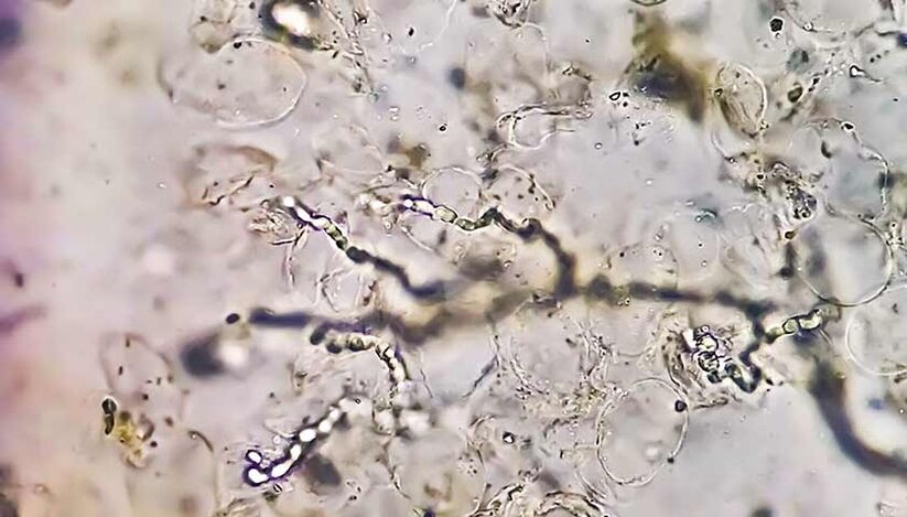 Fungos baixo o microscopio - o culpable do desenvolvemento da micose dos pés